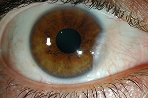 Pterygium